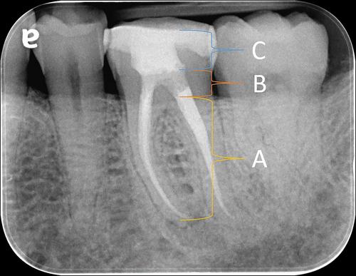 Biological considerations of dental materials as orifice barriers for restoring root-filled teeth