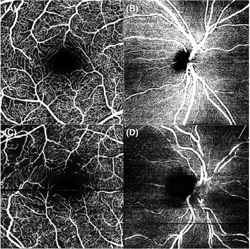 Ophthalmological involvement in wild-type transthyretin amyloidosis: A multimodal imaging study