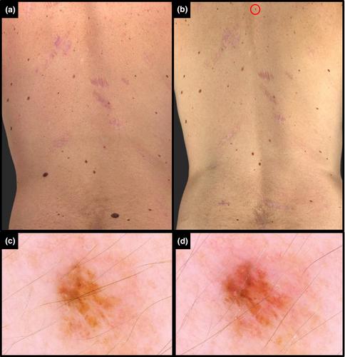 MITF E318K: A rare homozygous case with multiple primary melanoma