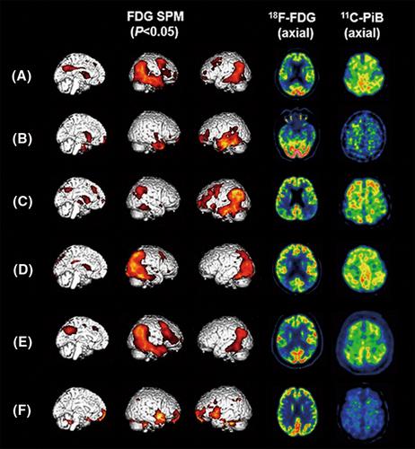 The value of FDG combined with PiB PET in the diagnosis of patients with cognitive impairment in a memory clinic