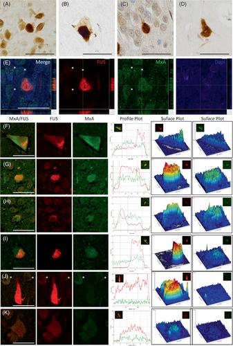 Increased expression of human antiviral protein MxA in FUS proteinopathy in amyotrophic lateral sclerosis