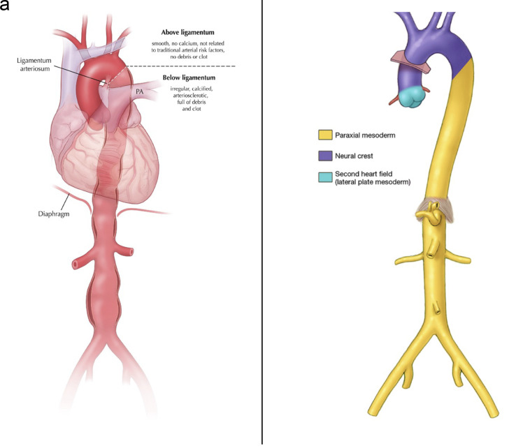 "Big Data" Analyses Underlie Clinical Discoveries at the Aortic Institute.