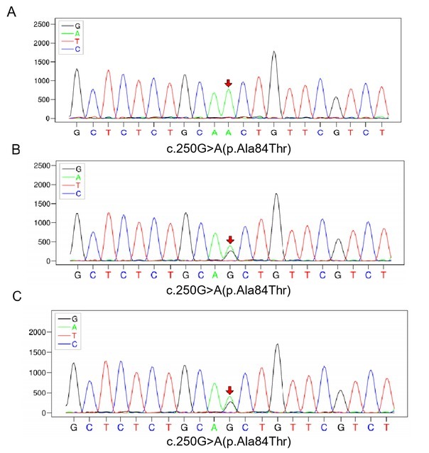 A rare condition that mimic myopathy: Late-onset glutaric acidaemia type II.