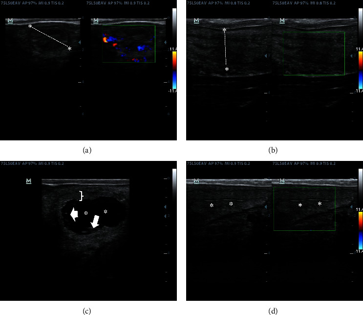 Ultrasonographic Screening of Dairy Cows with Normal Uterine Involution or Developing Postpartum Uterine Disease Using B-Mode, Color, and Spectral Doppler.