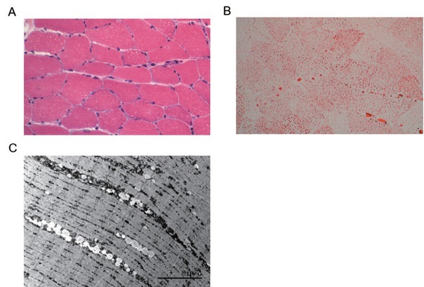 A rare condition that mimic myopathy: Late-onset glutaric acidaemia type II.