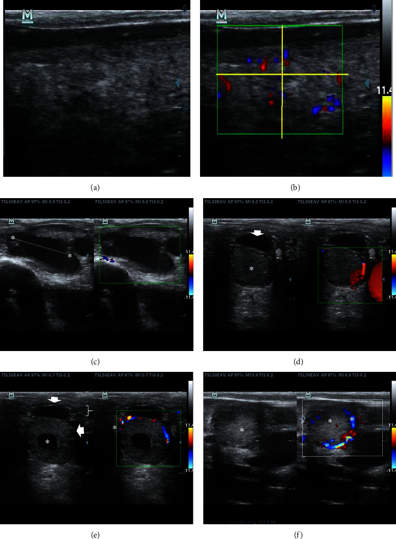 Ultrasonographic Screening of Dairy Cows with Normal Uterine Involution or Developing Postpartum Uterine Disease Using B-Mode, Color, and Spectral Doppler.