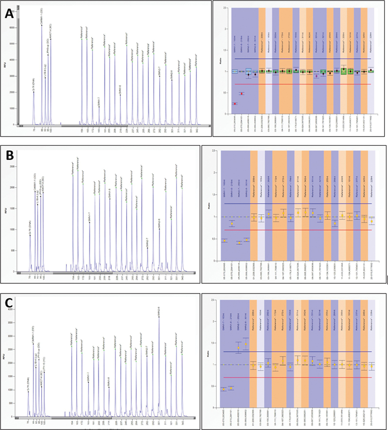 Lessons from Real Life Experience: Importance of In-House Sequencing and Smart Ratio-Based Real-Time PCR Outperform Multiplex Ligation-Dependent Probe Amplification in Prenatal Diagnosis for Spinal Muscular Atrophy: Bench to Bedside Diagnosis.