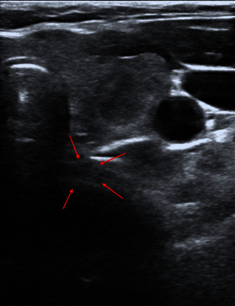 Ultrasound-Assisted Management for Tracheal Intubation in the Patient with Tracheal Diverticulum.