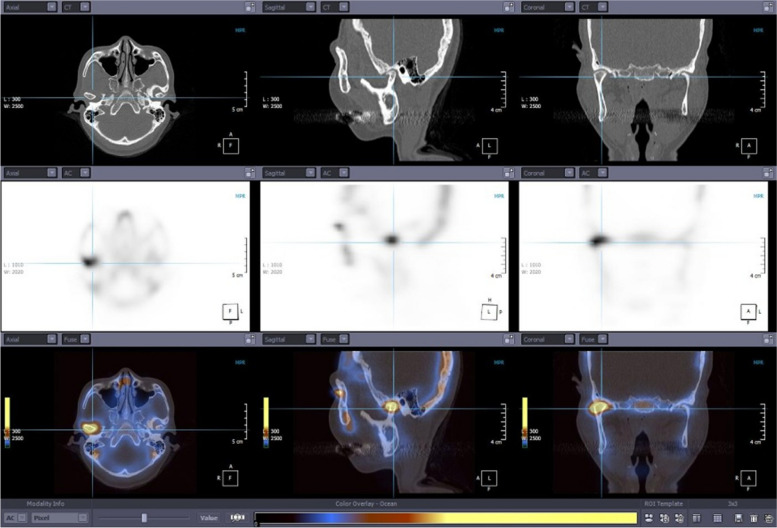 The clinical effectiveness of fused image of single-photon emission CT and facial CT for the evaluation of degenerative change of mandibular condylar head.