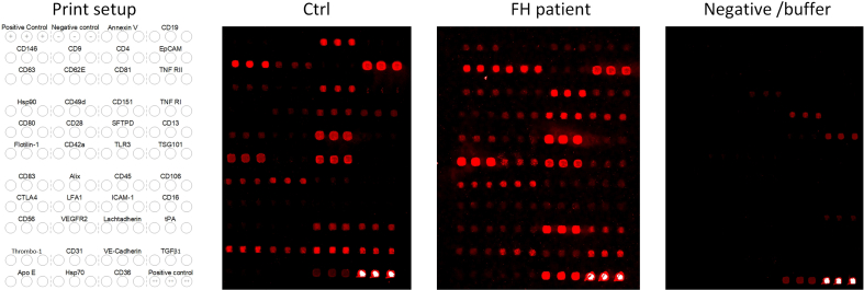 Increased extracellular vesicles (EVs) related to T cell-mediated inflammation and vascular function in familial hypercholesterolemia