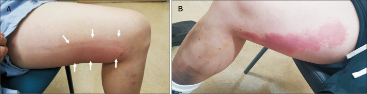 Complex Hypersensitivity and Irritation Reaction (CHAIR) Phenomenon after Cyanoacrylate Closure of Varicose Vein.