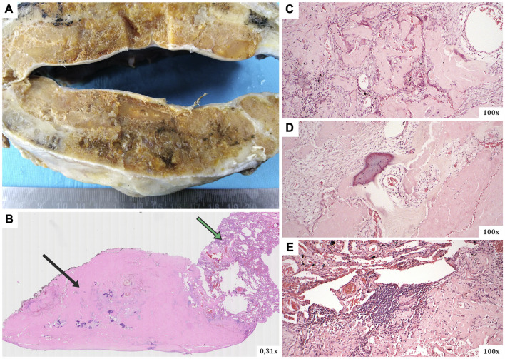 A unique case of AH-dominant type nodular pulmonary amyloidosis presenting as a spontaneous pneumothorax: a case report and review of the literature.