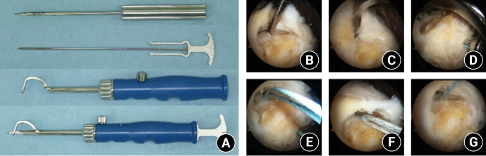 Arthroscopic transosseous anchorless rotator cuff repair reduces bone defects related to peri-implant cyst formation: a comparison with conventional suture anchors using propensity score matching.