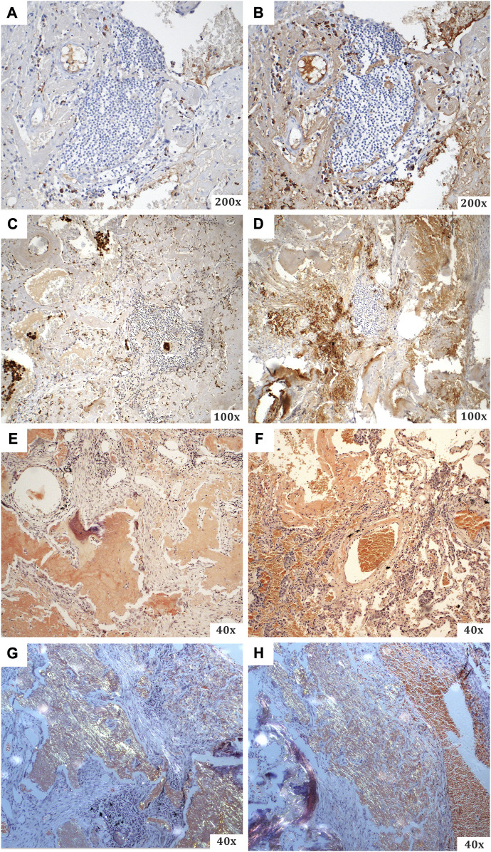 A unique case of AH-dominant type nodular pulmonary amyloidosis presenting as a spontaneous pneumothorax: a case report and review of the literature.