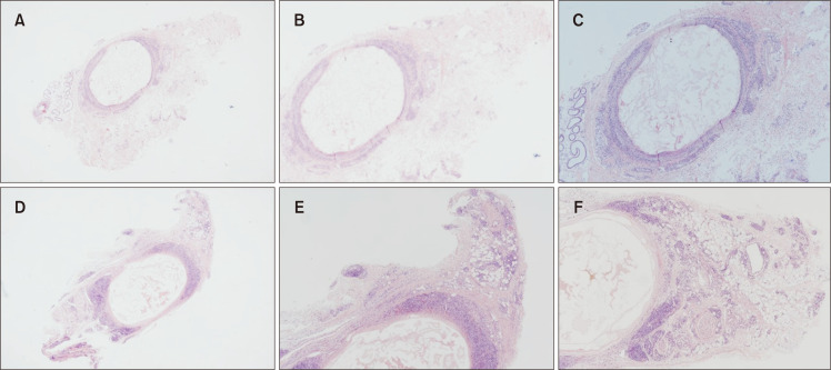 Complex Hypersensitivity and Irritation Reaction (CHAIR) Phenomenon after Cyanoacrylate Closure of Varicose Vein.