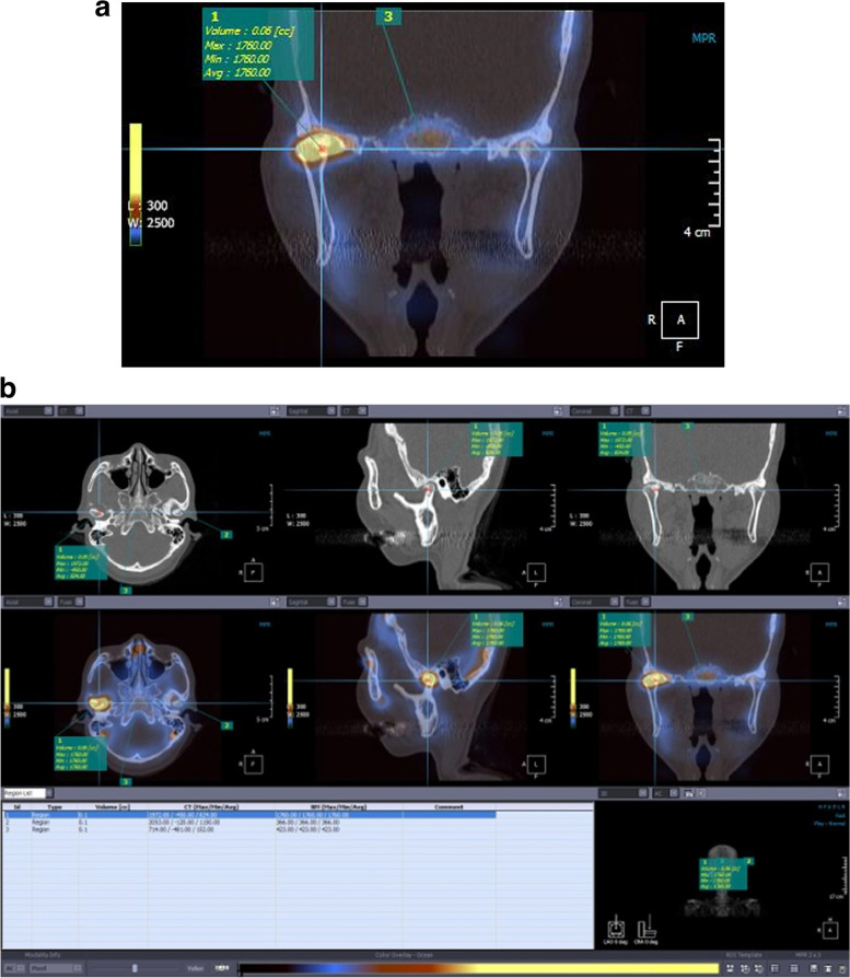 The clinical effectiveness of fused image of single-photon emission CT and facial CT for the evaluation of degenerative change of mandibular condylar head.