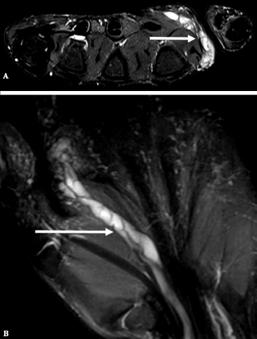 A rare case of an intraneural ganglion cyst of the median nerve.