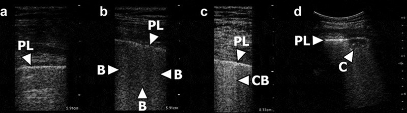 Thoracic ultrasonographic and clinical findings at 12-month follow-up of patients admitted with COVID-19.