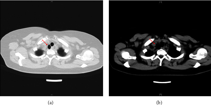 Ultrasound-Assisted Management for Tracheal Intubation in the Patient with Tracheal Diverticulum.