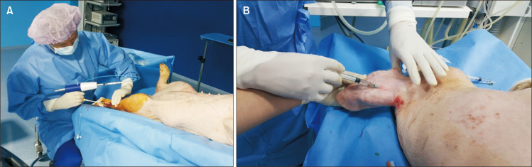 Complex Hypersensitivity and Irritation Reaction (CHAIR) Phenomenon after Cyanoacrylate Closure of Varicose Vein.