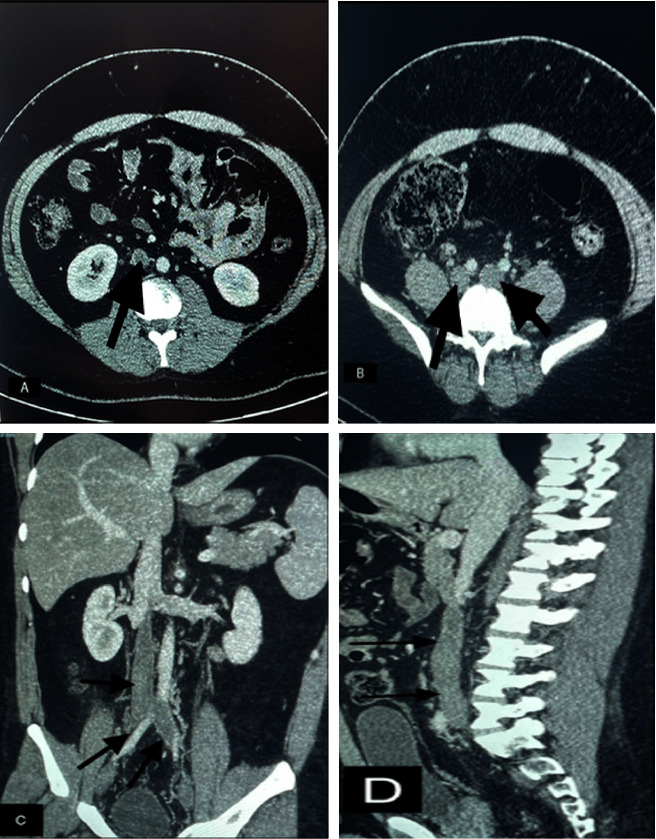 Inferior Vena Cava Thrombosis in a Patient with Factor V Leiden Syndrome Presenting with Scrotal Pain.