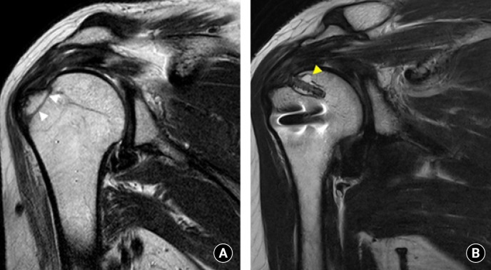 Arthroscopic transosseous anchorless rotator cuff repair reduces bone defects related to peri-implant cyst formation: a comparison with conventional suture anchors using propensity score matching.