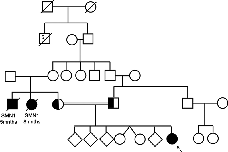 Lessons from Real Life Experience: Importance of In-House Sequencing and Smart Ratio-Based Real-Time PCR Outperform Multiplex Ligation-Dependent Probe Amplification in Prenatal Diagnosis for Spinal Muscular Atrophy: Bench to Bedside Diagnosis.