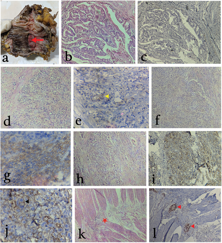 Cluster of Differentiation 44 Expression in Gastrointestinal Malignancies: A Study from South India.