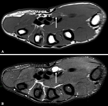 A rare case of an intraneural ganglion cyst of the median nerve.