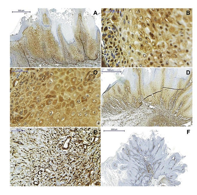 The stromal immunoexpression of CLIC4 may be related to the difference in the biological behavior between oral squamous cell carcinoma and oral verrucous carcinoma.