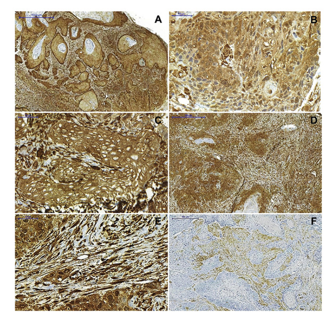 The stromal immunoexpression of CLIC4 may be related to the difference in the biological behavior between oral squamous cell carcinoma and oral verrucous carcinoma.