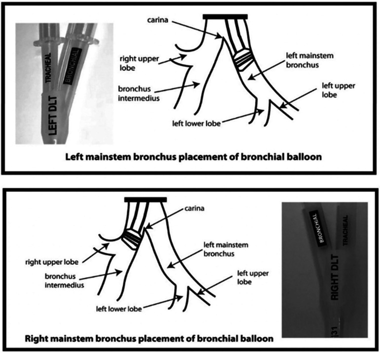 Research and development of the sOLVe Tube™ dual lumen endobronchial tube: from concept to construct.