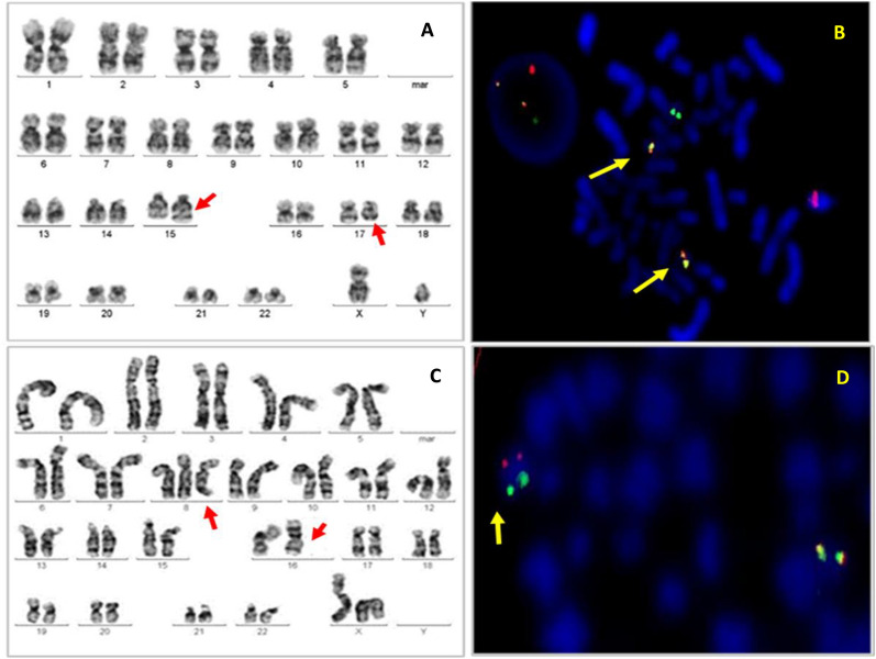 Cytogenetic profile of 1791 adult acute myeloid leukemia in India.