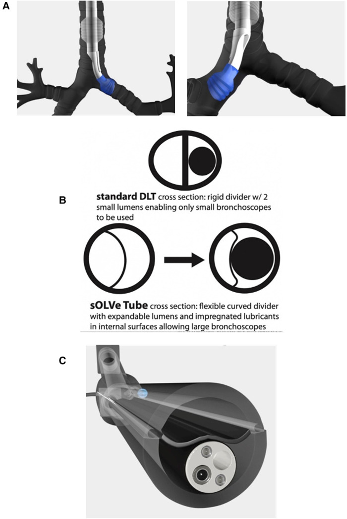 Research and development of the sOLVe Tube™ dual lumen endobronchial tube: from concept to construct.