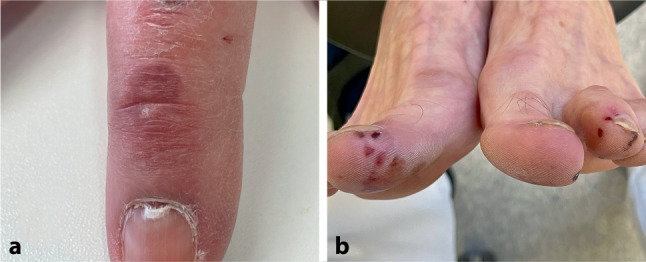 Post-SARS-CoV-2 vaccination COVID toes and fingers : Two case reports and a short literature review.