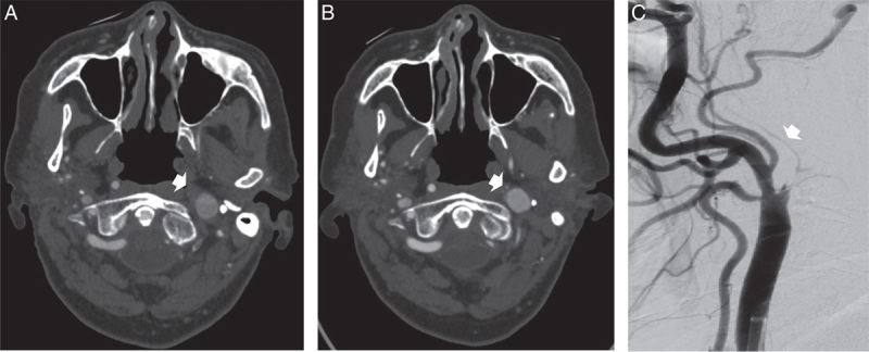 Spontaneous Recanalization of Internal Carotid Artery Occlusion: A Case Report.