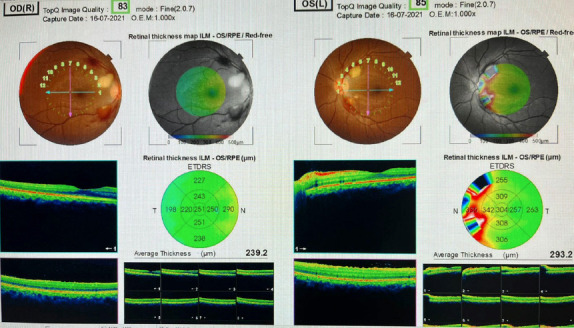 Ocular Manifestations of Wernicke's Encephalopathy in a Patient with Hyperemesis Gravidarum Complicating Pregnancy.