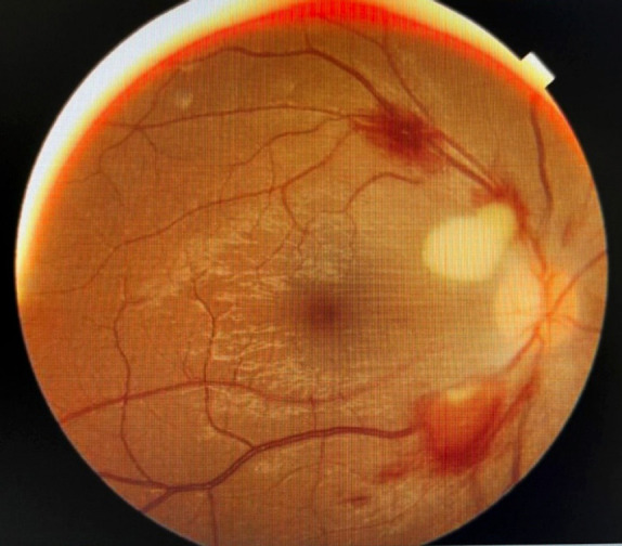 Ocular Manifestations of Wernicke's Encephalopathy in a Patient with Hyperemesis Gravidarum Complicating Pregnancy.