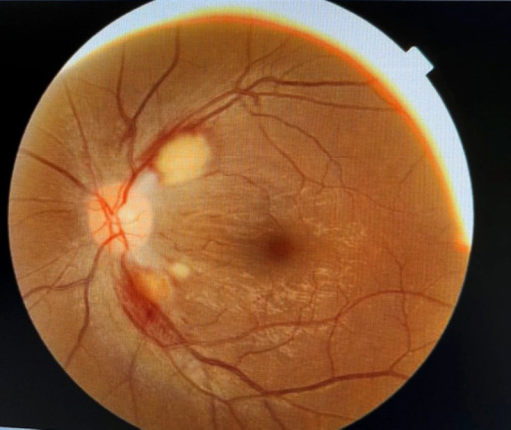 Ocular Manifestations of Wernicke's Encephalopathy in a Patient with Hyperemesis Gravidarum Complicating Pregnancy.