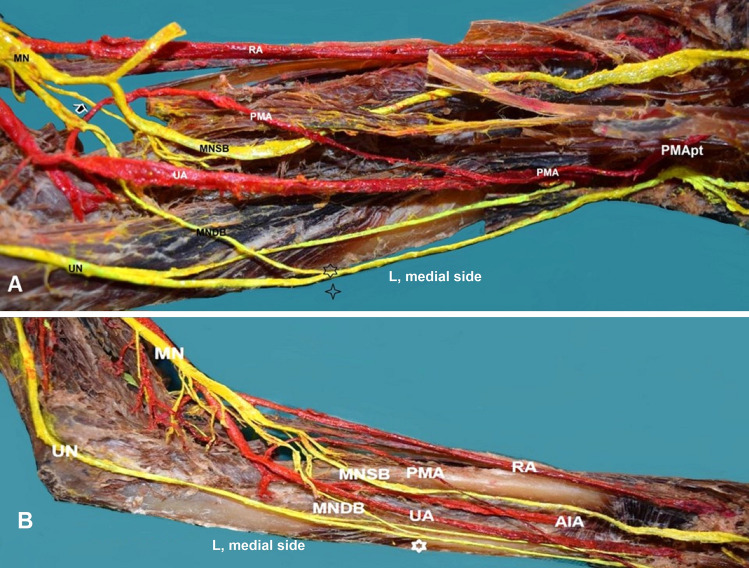 Median artery persistence in coexistence with a bifid median nerve and interconnections of the median with the ulnar nerve and vice versa.