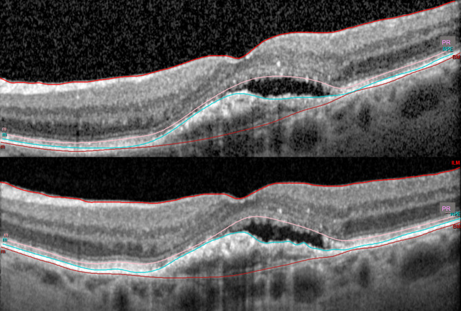 Diurnal variation of optical coherence tomography-based macular fluid in exudative age-related macular degeneration.