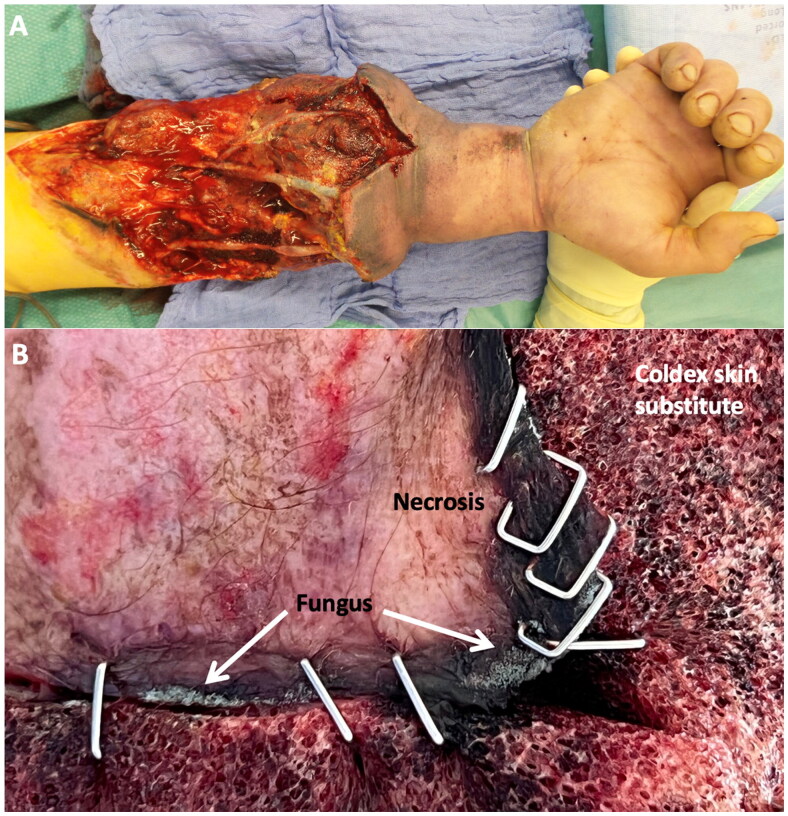 Mucor osteomyelitis after traumatic forearm amputation in a 38-year-old patient.