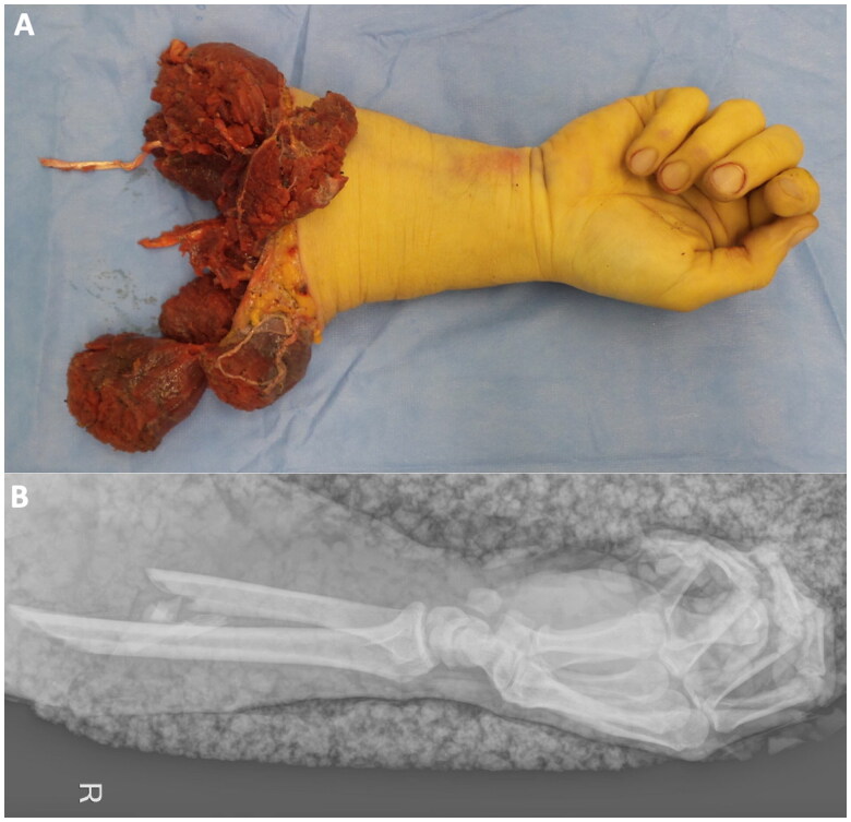 Mucor osteomyelitis after traumatic forearm amputation in a 38-year-old patient.