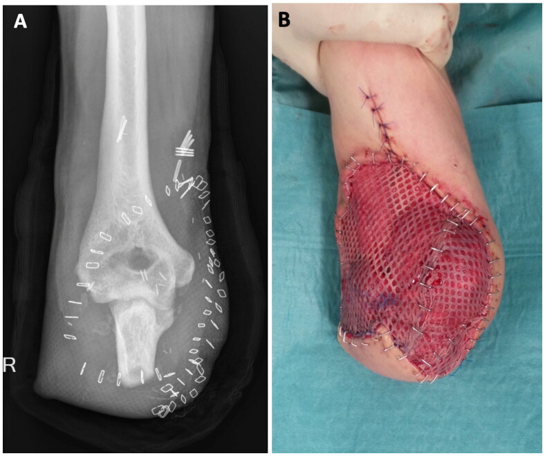 Mucor osteomyelitis after traumatic forearm amputation in a 38-year-old patient.