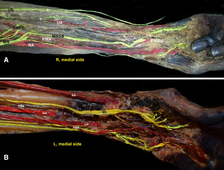 Median artery persistence in coexistence with a bifid median nerve and interconnections of the median with the ulnar nerve and vice versa.