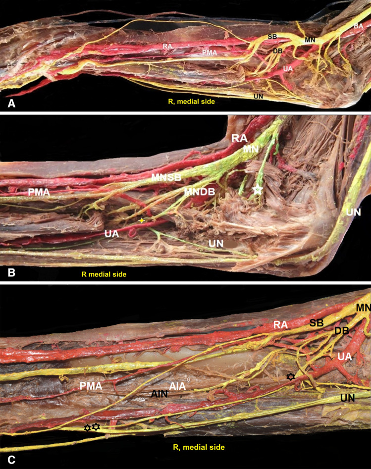 Median artery persistence in coexistence with a bifid median nerve and interconnections of the median with the ulnar nerve and vice versa.