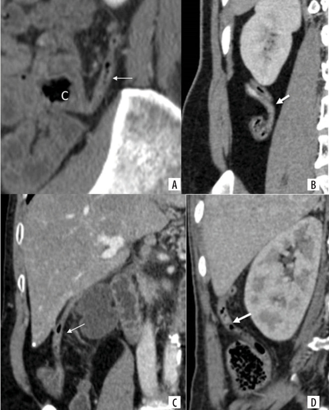 Computed tomography evaluation of variations in positions and measurements of appendix in patients with non-appendicular symptoms: time to revise the diagnostic criteria for appendicitis.