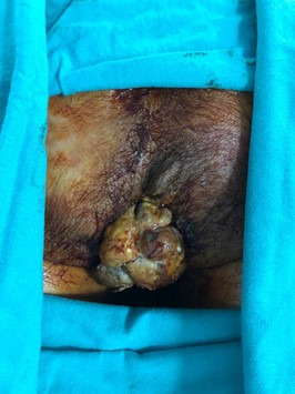 Bleeding metastasis of renal cell cancer to anal canal treated with radiation.