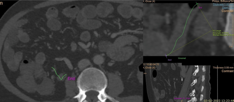 Computed tomography evaluation of variations in positions and measurements of appendix in patients with non-appendicular symptoms: time to revise the diagnostic criteria for appendicitis.