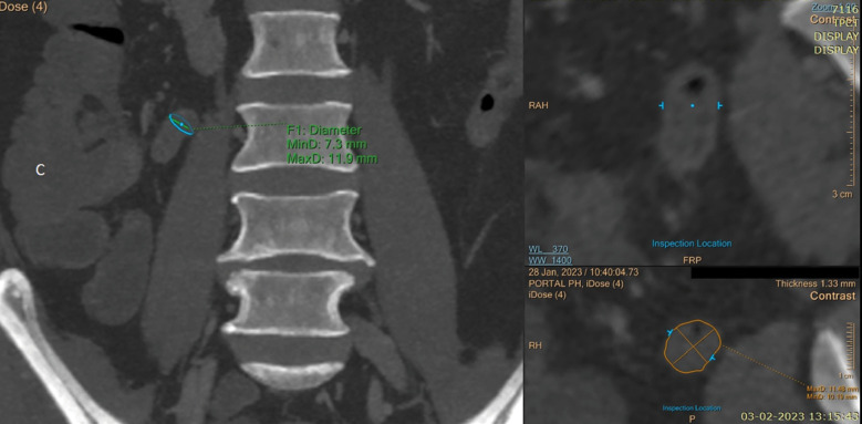 Computed tomography evaluation of variations in positions and measurements of appendix in patients with non-appendicular symptoms: time to revise the diagnostic criteria for appendicitis.